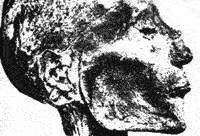 Рис. 22. Древность возбудителей натуральной оспы и СПИДа. Мумия Рамзеса V, умершего в 1157 г. до н.э. Четко видны следы оспенных пустул — археологическое подтверждение существования оспы в древнем Египте. Однако живший 7 столетий позже Гиппократ (IV век до н.э.) об оспе ничего не знает. И только спустя еще 6 столетий, натуральную оспу описывает римский врач Гален (II век). Тогда она не кажется современникам грозной болезнью. Но в XVII столетии оспа превращается в то страшное бедствие — черную смерть, которое, как мы считаем сегодня, побеждено навсегда.