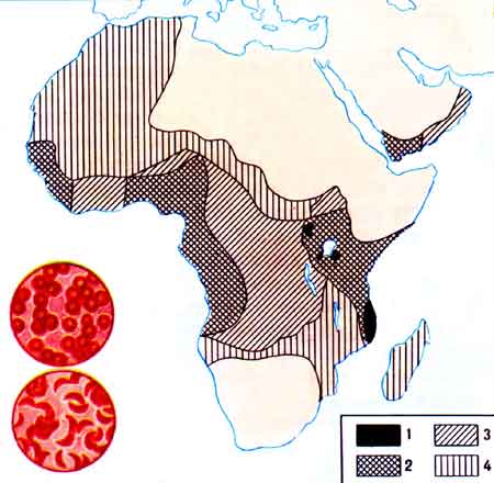 Рис. 53. Распространение серповидно-клеточной анемии в Африке.